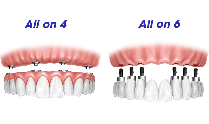 All-on-4 All-on-6 tam implant