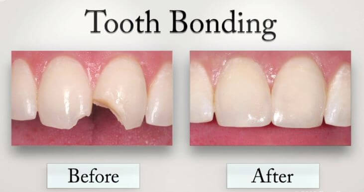 Bonding Yöntemi ile kırık diş tedavisi