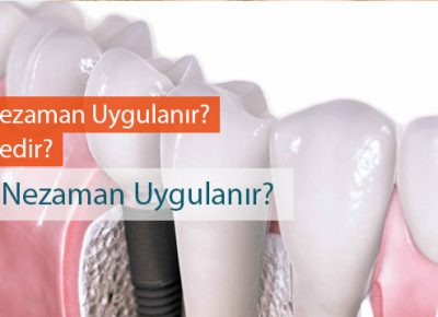 İmplant Diş Yapımı