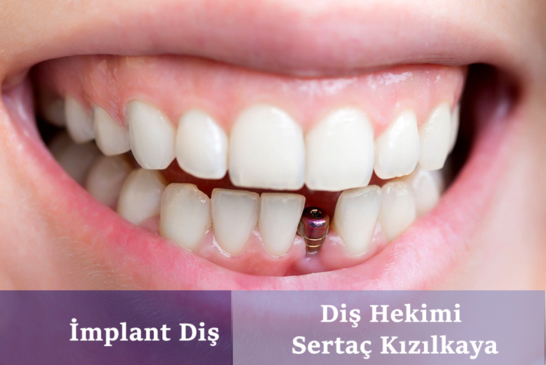 İstanbul implant diş kliniği