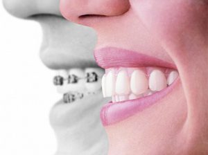 Diş teli tedavisi nedir?