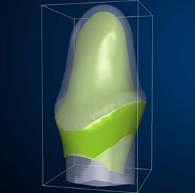 Cerec Diş Kaplama bilgisayarlı diş tasarımı ve uygulaması