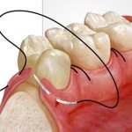 Ağıza Dikiş Atılması