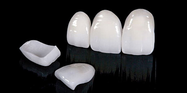 Porselen lamina diş yapımı