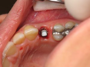 Ön diş implant uygulaması