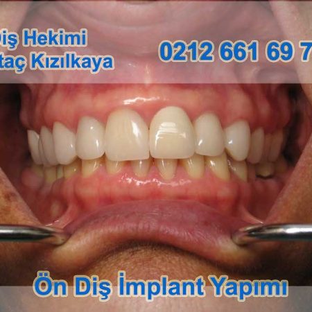 Ön diş implant yapımı