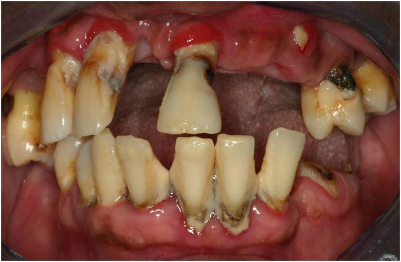 İlerlemiş diş eti hastalığı nedeni ile kaybedilmiş dişler