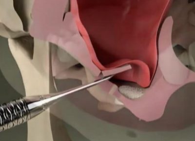 SİNÜS LİFTİNG KEMİK TOZU