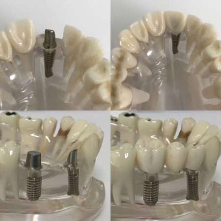 İmplant diş yapımı model üzerinde gösterilmiştir.