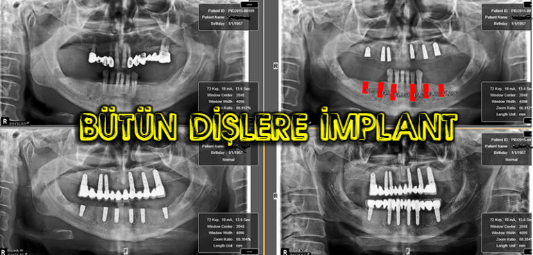 Bütün Dişler Komple İmplant