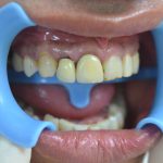 İyi Yapılmayan Zirkonyum Diş Kaplama Sonuçları