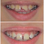 Kompozit Diş Dolgusu