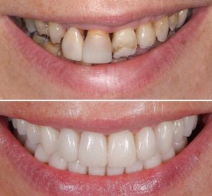 İmplant diş tedavisi ile eksik dişlerinize veda edin. Diş Hekimi Sertaç Kızılkaya İstanbul diş kliniğinde zirkonyum ve implant çözümleriyle estetik bir gülüşe kavuşun.