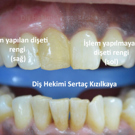 Diş ve diş eti renklenmesi tedavisi