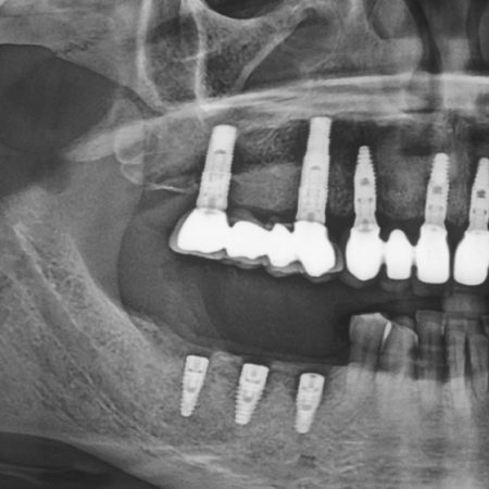 osstem implant röntgeni