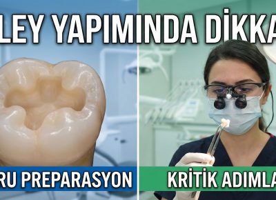 inley onley porselen diş dolgusu