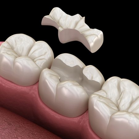 inlay onley porselen diş dolgusu