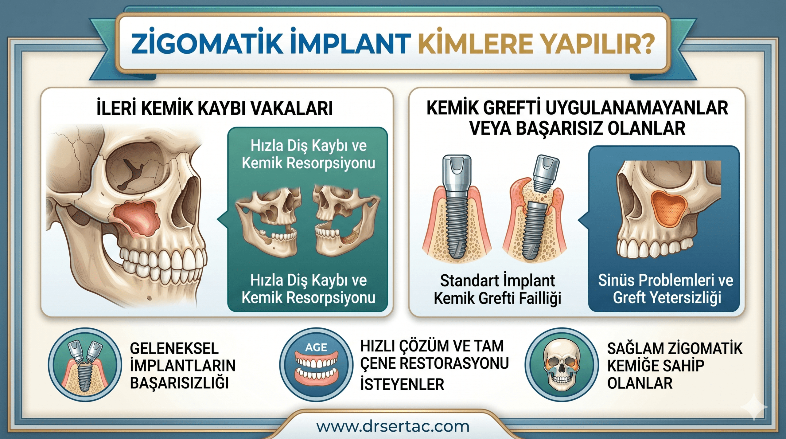 zigomatik implant kimlere yapılır