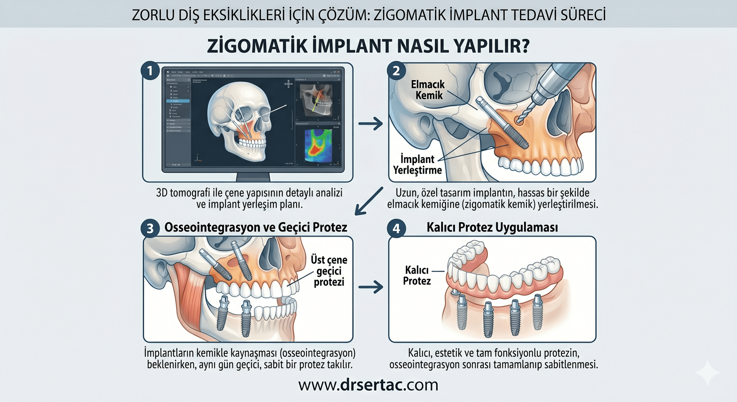 zigomatik-implant-nasıl-yapılır