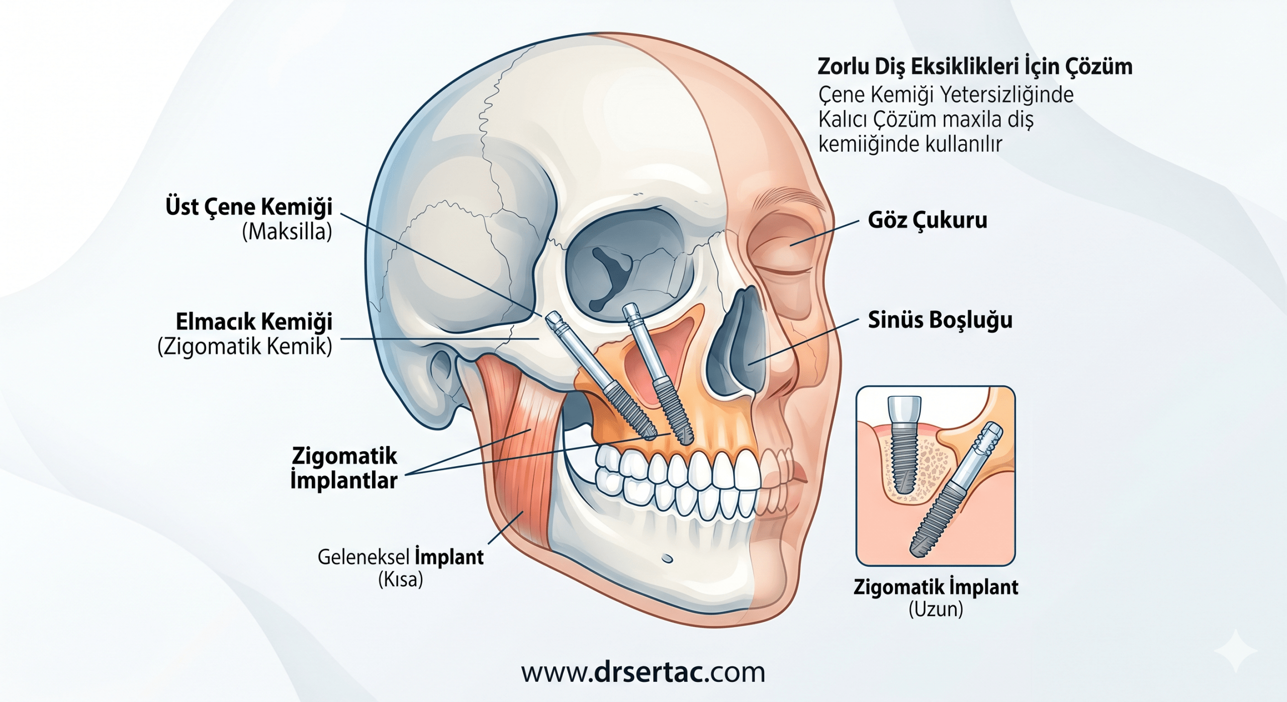 ZİGOMATİK İMPLANT NASIL YAPILIR?